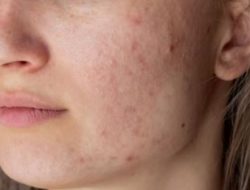 10 Cara Cepat dan Efektif Menghilangkan Bekas Jerawat, Kulit Mulus Kembali