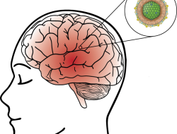 Mengapa Campak Bisa Menyebabkan Radang Otak?